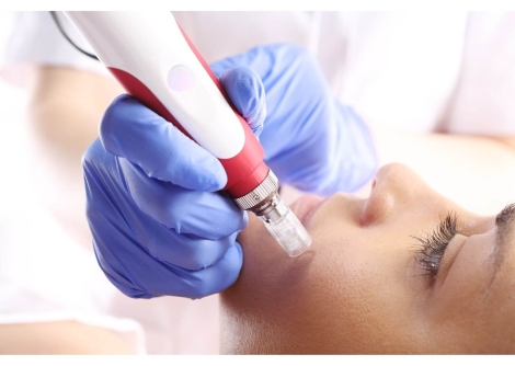 Mezoterapia mikroigłowa